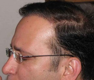 After Hair Implant 